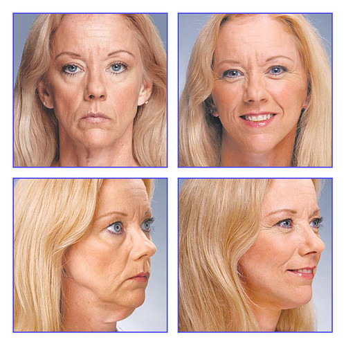 How Much Does A Neck Lift Cost In the UK?